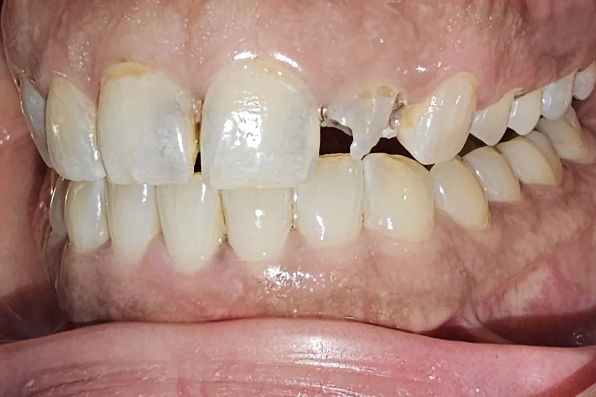 Before: An upper front tooth broken away by decay, leaving a gap