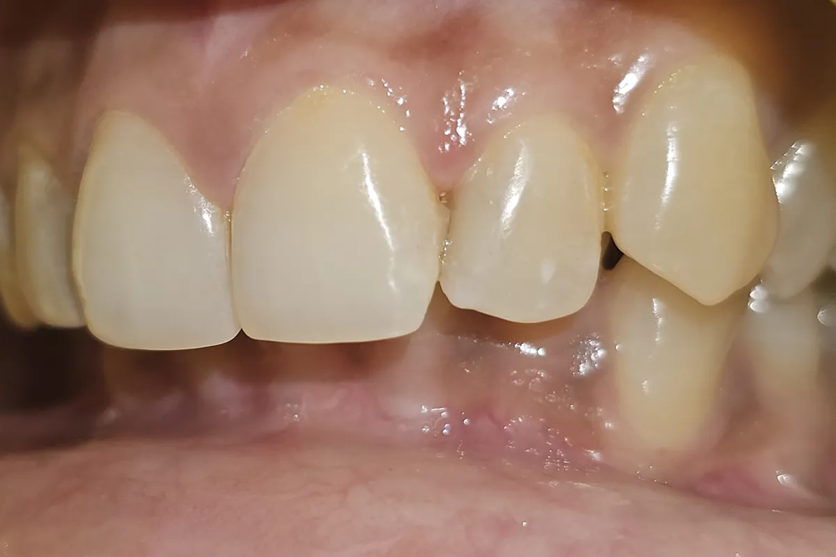 After: The same teeth filled, with no visible decay