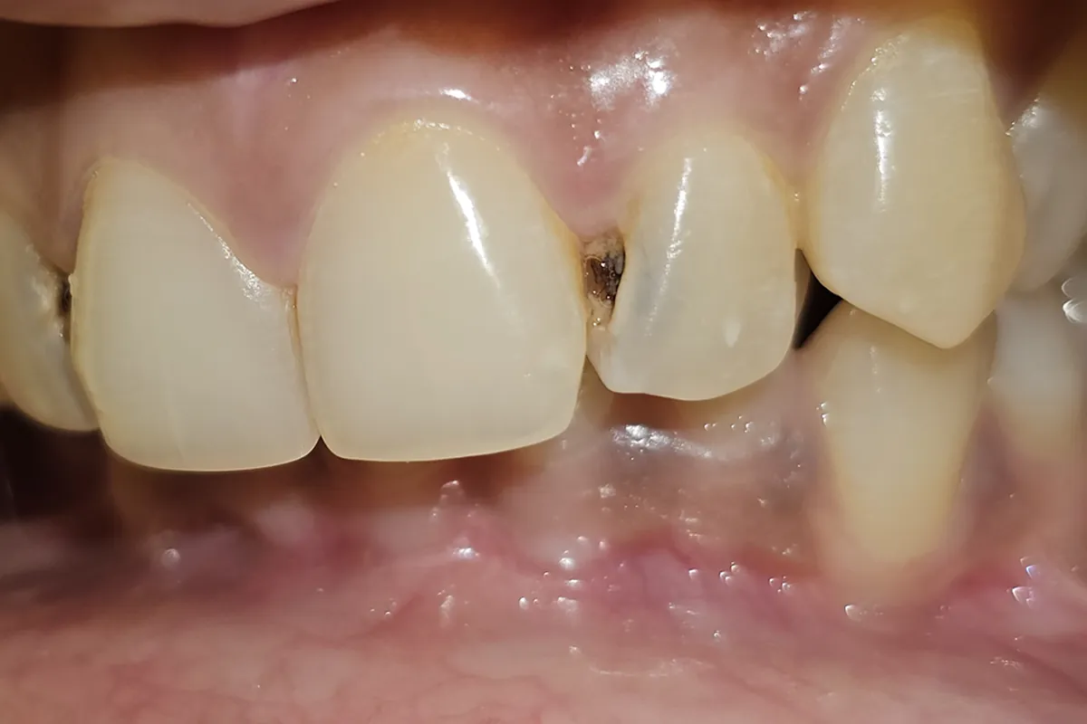 Before: Dark decay between two upper front teeth