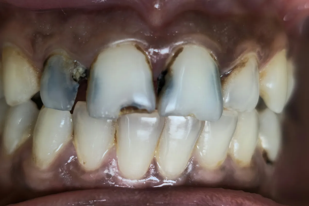 Before: Upper front teeth dark grey and broken at the edges, with decay between them