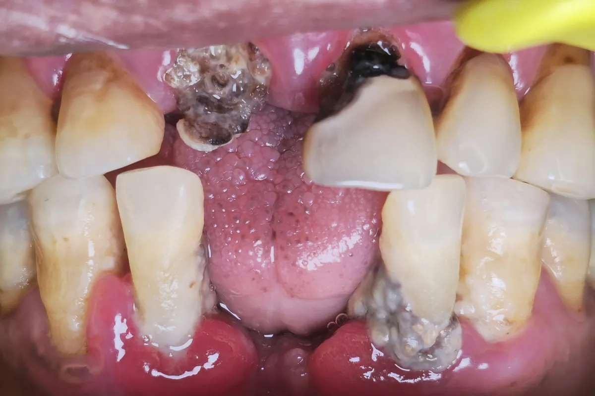 Before: Upper front teeth missing or decayed to the gum, with gaps in the lower front teeth